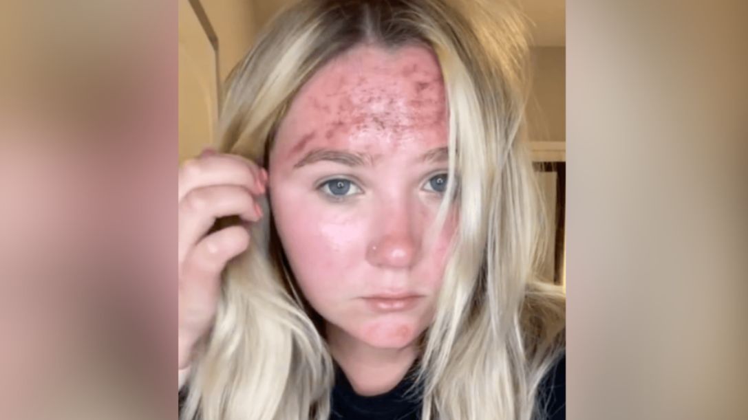 Leczenie trwało niemal trzy tygodnie