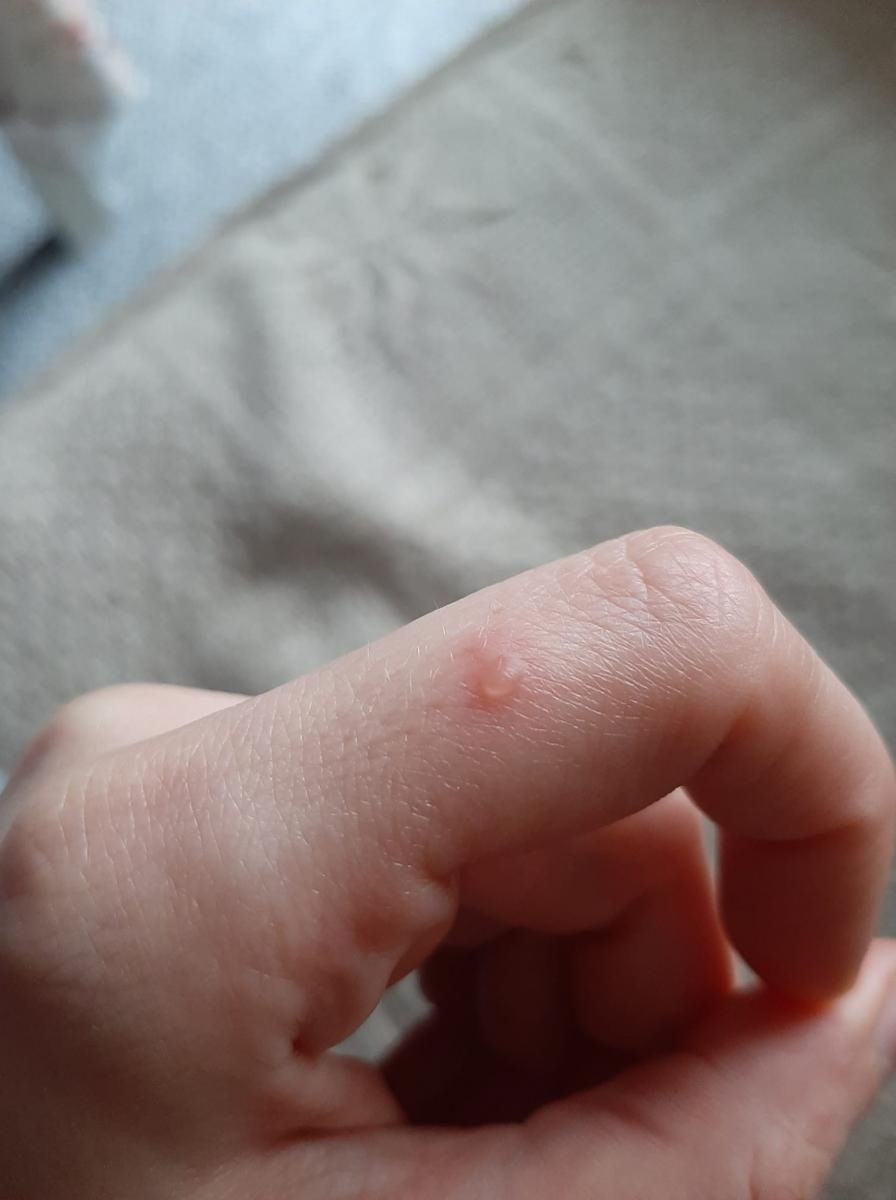 COVID-19 może aktywować chorobę autoimmunologiczną