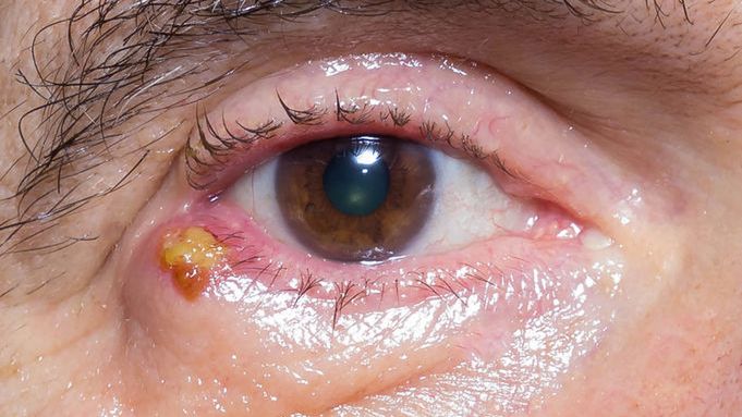 Jęczmień na oku