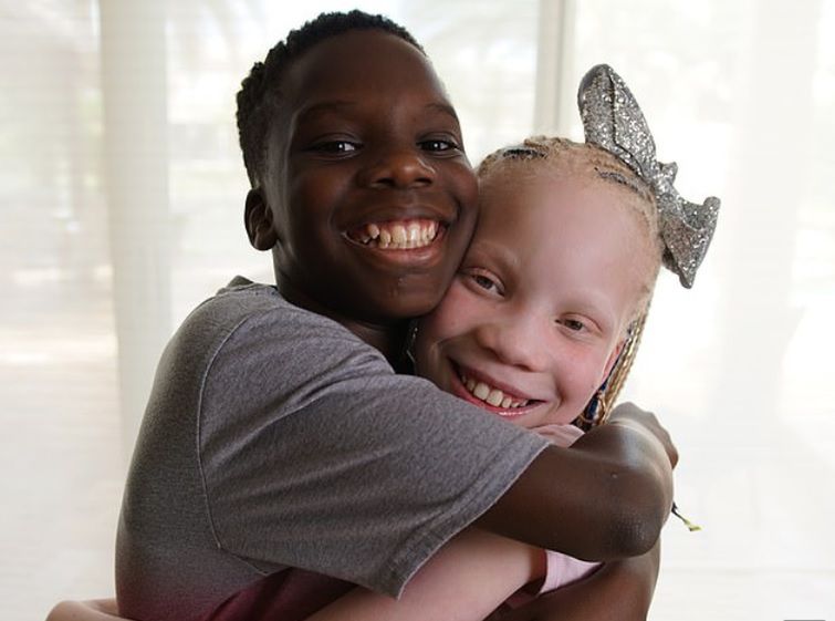 Są bliźniętami, ale wyglądają zupełnie inaczej. Jedno z nich cierpi na albinizm