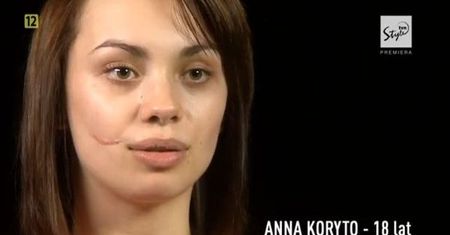 Anna Koryto na operacyjnym stole! Bliznę usunięto jej w "Sekretach chirurgii"!