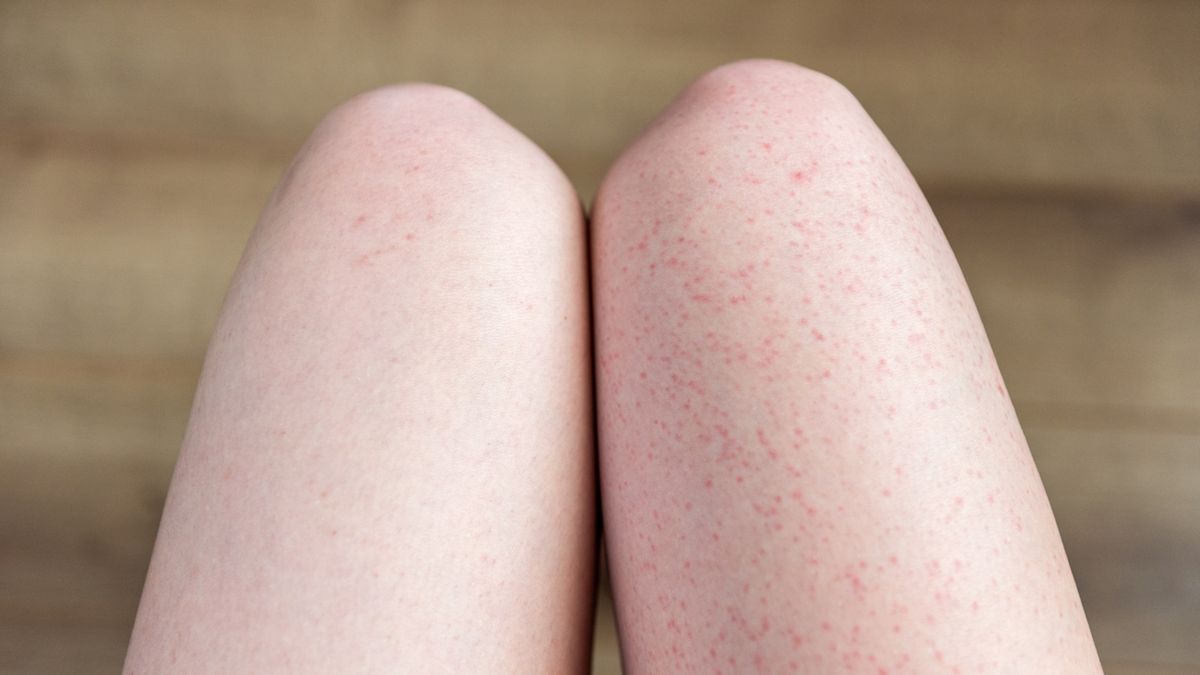 Truskawkowe nogi często są skutkiem podrażnienia mieszków włosowych
