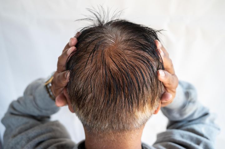 Wypadanie włosów może zwiastować problemy z jelitami. Sprawdź, jak wzmocnić mikrobiotę