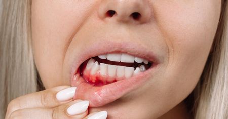 Alarmujący objaw raka krwi. Występuje podczas mycia zębów