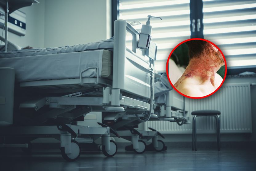 Zachoruje nawet co trzeci Polak. "To są naprawdę bardzo cierpiący ludzie"