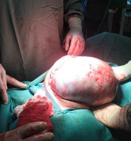 W Kaliszu lekarze usunęli łagodny guz jajnika 42-letniej pacjentce