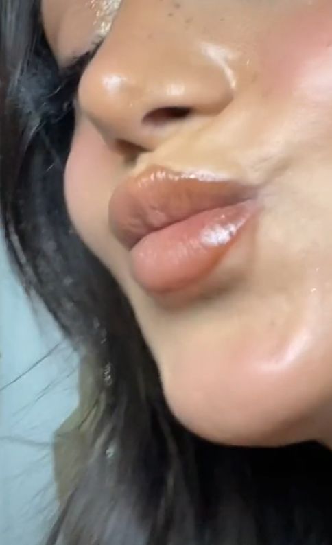 Wizażystka pokazała, jak wypełniacz przemieścił się poza wargi