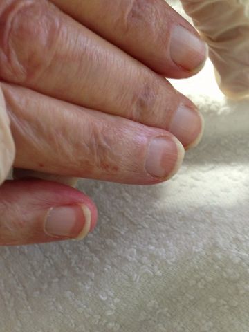 Zmany na paznokciach mogą być objawem choroby 