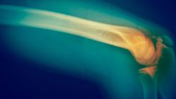 Rak kości. Czym się objawia? (WIDEO)