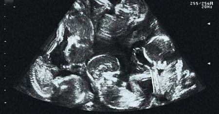 Niezwykłe zdjęcie z USG. Ile dzieci widzisz?