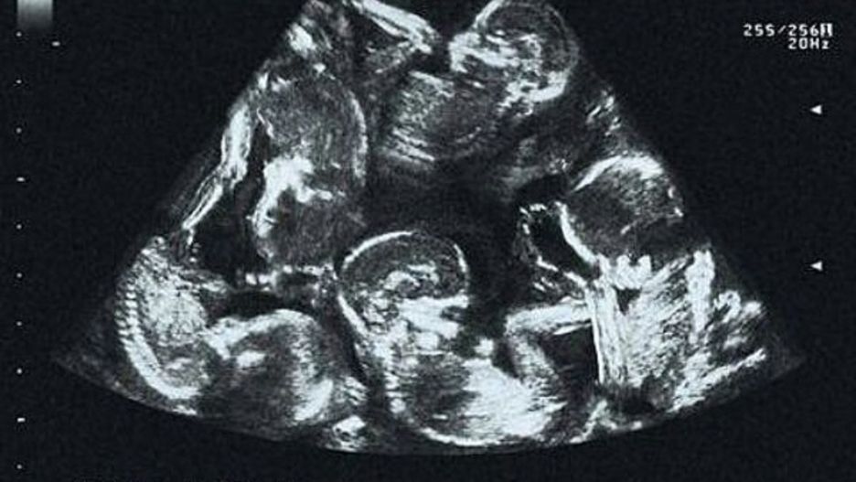 Niezwykłe zdjęcie z USG. Ile dzieci widzisz?