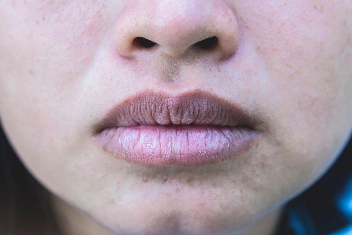 Sine usta, skóra i paznokcie mogą być objawem COVID-19