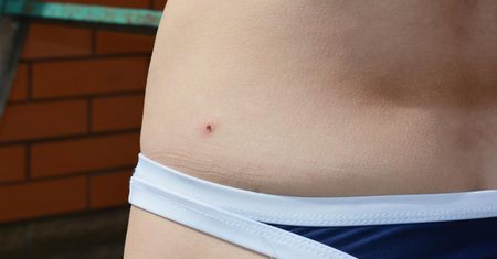 Co zrobić, gdy ugryzł cię kleszcz? Instrukcja krok po kroku