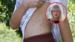 Żółtaczka to najbardziej widoczny znak raka wątroby. Ma go 40 proc. chorych