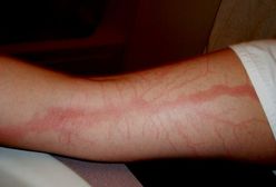 Przeżyli uderzenia piorunów!