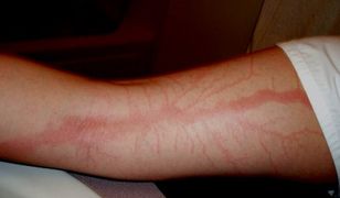 Przeżyli uderzenia piorunów!