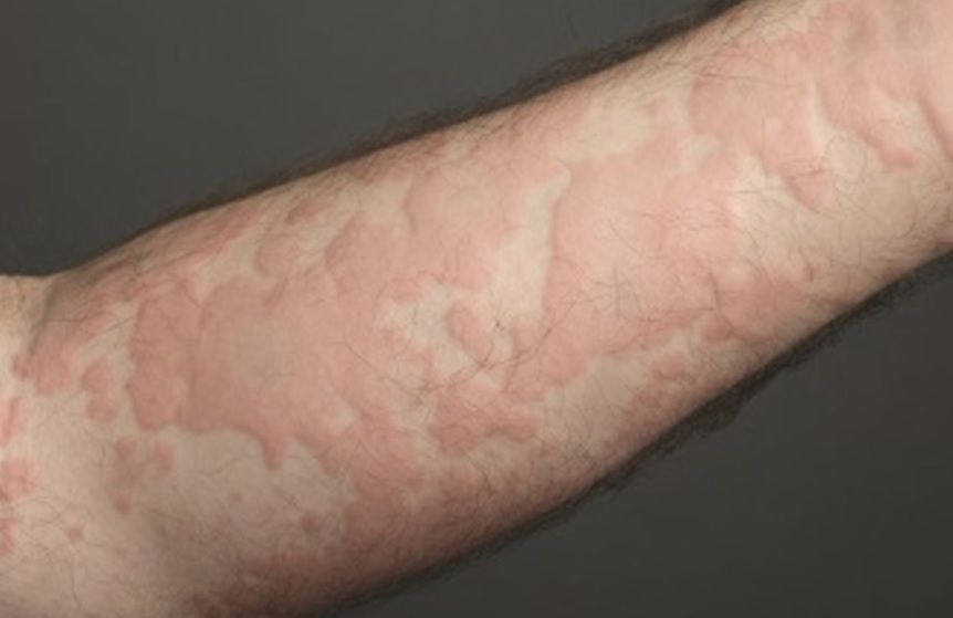 Pokrzywka przy COVID-19