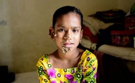 10-letnia Sahana Khatun - pierwszy przypadek "człowieka drzewo" płci żeńskiej na świecie