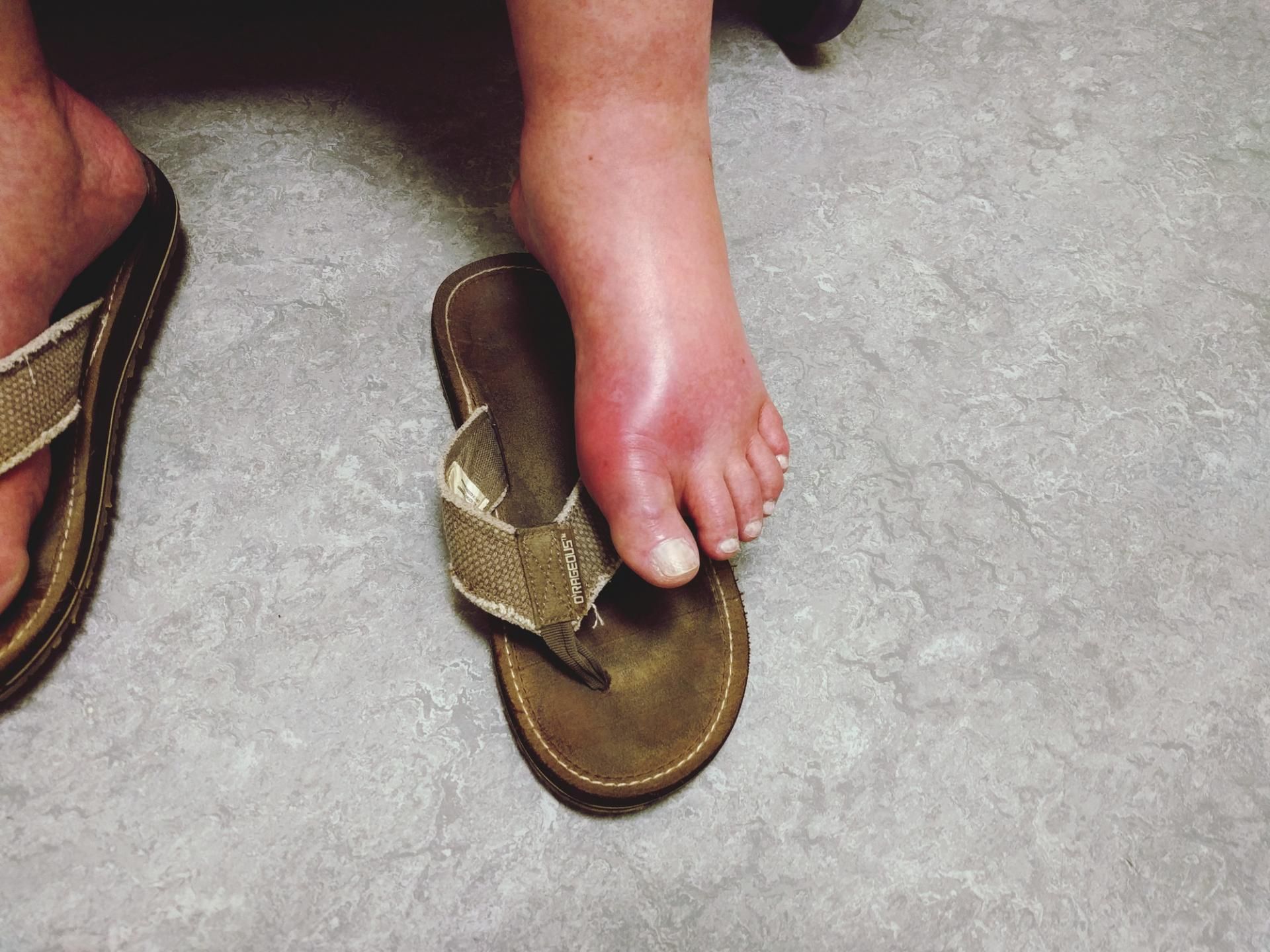 Obrzęk stóp może wskazywać na marskość wątroby