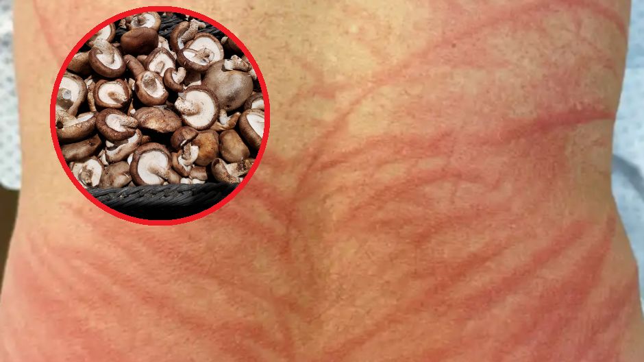 Nie mógł spać z powodu swędzącej wysypki. Źle ugotował grzyby