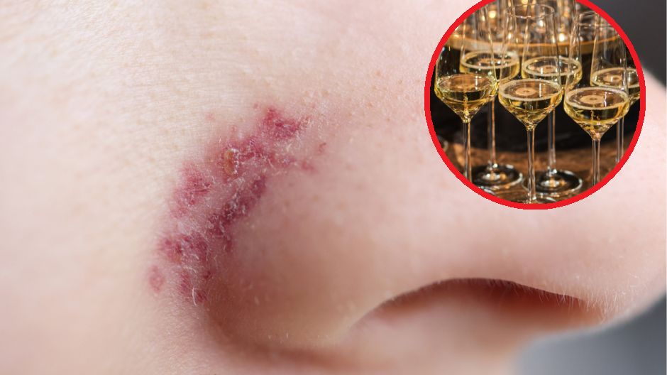 Niszczy nie tylko narządy, ale również wpływa na nasz wygląd. Te objawy od razu zauważysz na skórze