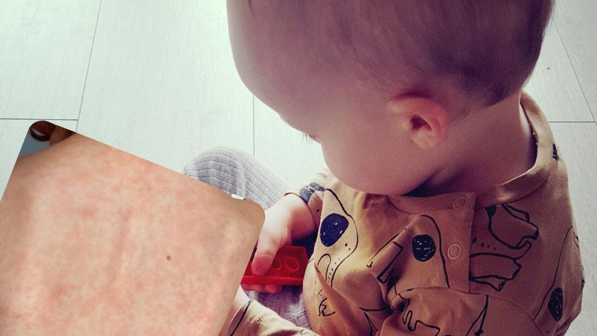 COVId-19 u dzieci może mieć ciężki przebieg