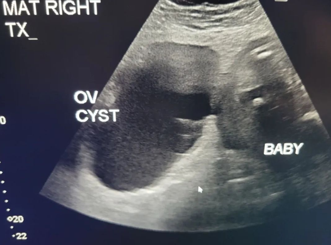 Torbiel była dwa razy większa od dziecka