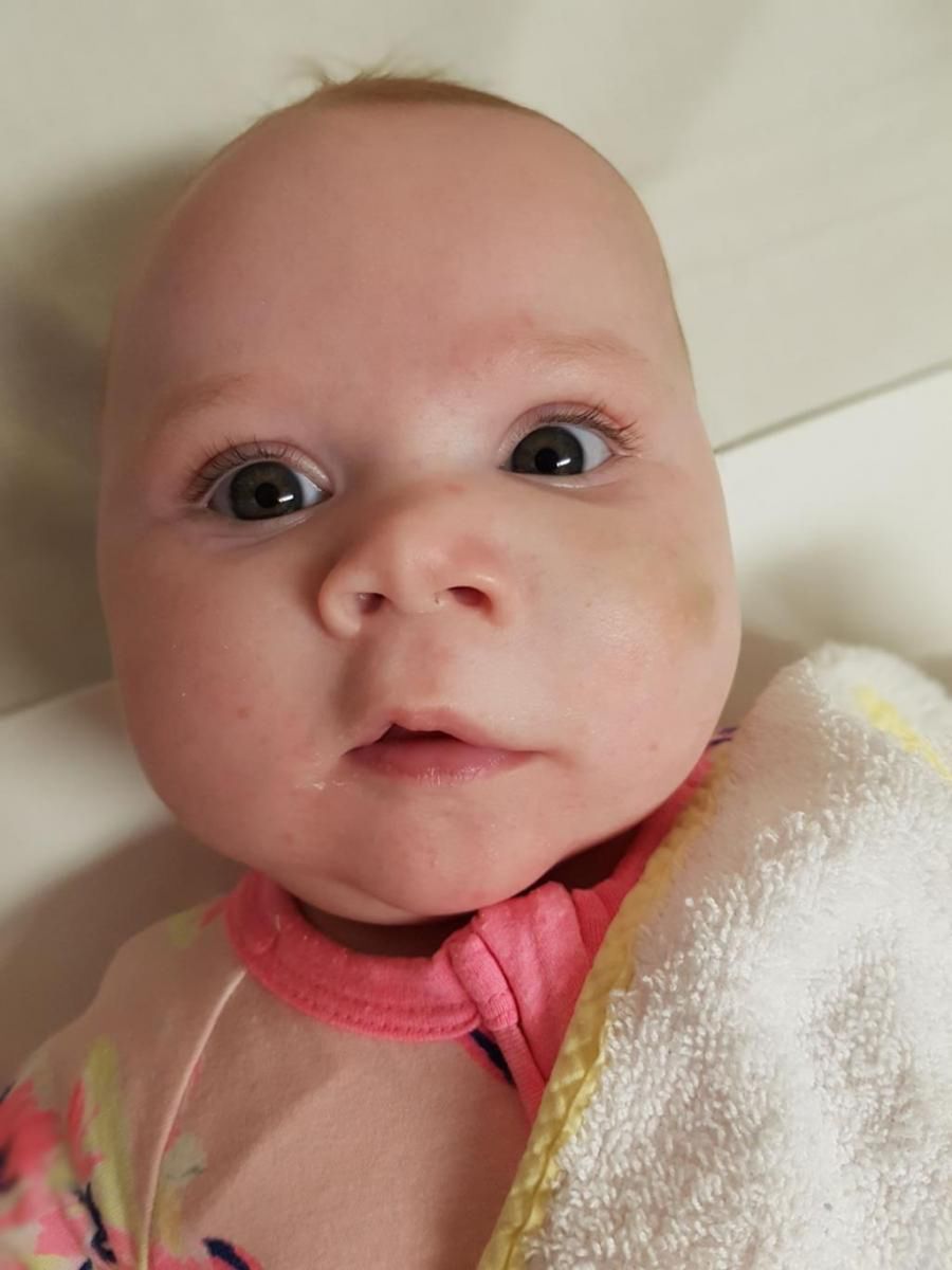 Mama zauważyła małą plamkę na twarzy Lilly