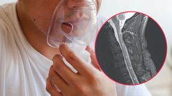 Tak gaz rozweselający może uszkodzić kręgosłup. Jego używanie grozi paraliżem