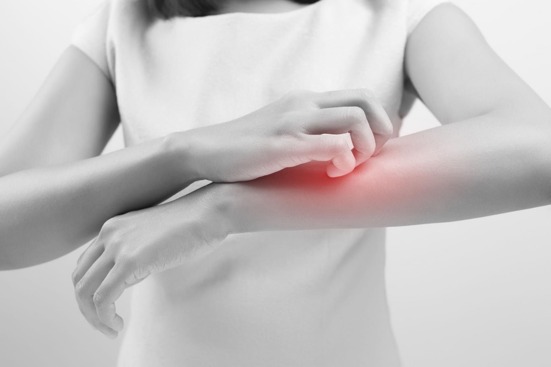 Atopowe zapalenie skóry to częsty i nieprzyjemny problem