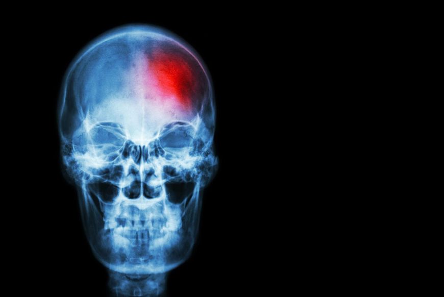 Według Amerykańskiej Fundacji Migreny tak intensywny ból może być jednym z ostatnich sygnałów zbliżającego się udaru, pęknięcia tętniaka czy krwotoku mózgu