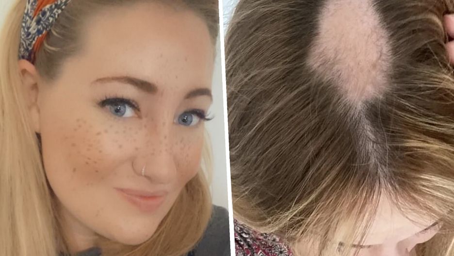 Skutki uboczne COVID-19 zauważyli jej bliscy. "Mamusia łysieje"