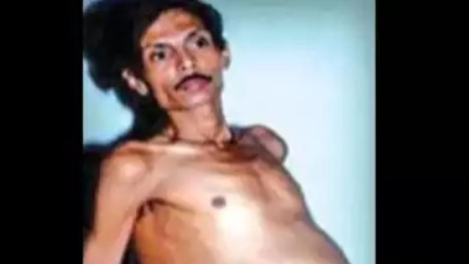 Niesamowity przypadek medyczny. Przez 36 lat nosił w sobie bliźniaka