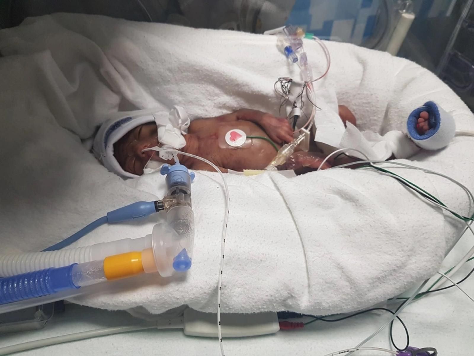 Chłopiec przyszedł na świat 24-tym tygodniu ciąży.