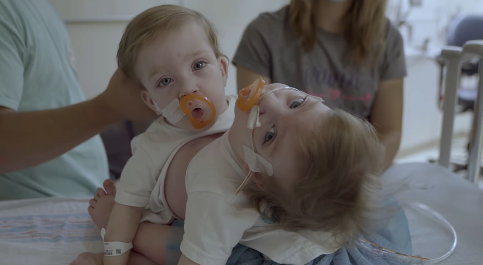 Sarabeth i Amelia przed operacją rozdzielenia