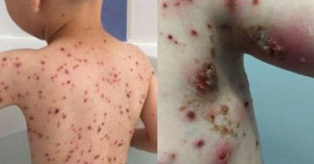 Podała synowi ibuprofen w czasie ospy. Chłopiec walczył o życie