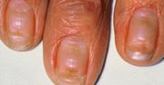 Znak, że cukrzyca już zaatakowała. Charakterystyczny szczegół widać na paznokciach