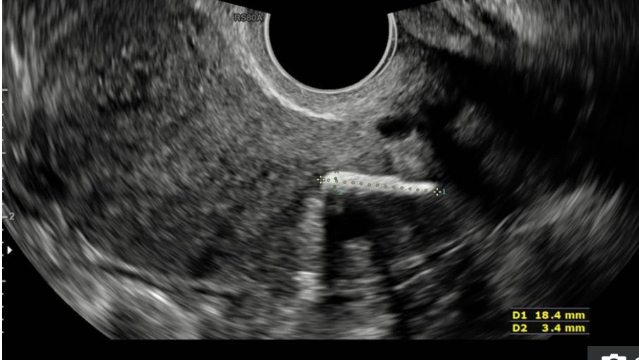 Miała aborcję 20 lat temu. W ciele pozostała kość płodu, która uniemożliwiała zajście w ciążę