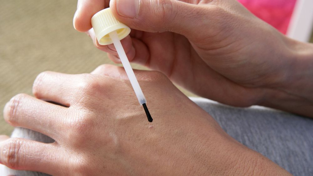 Na kurzajki można stosować wiele środków, m.in. sok z glistnika lekarskiego