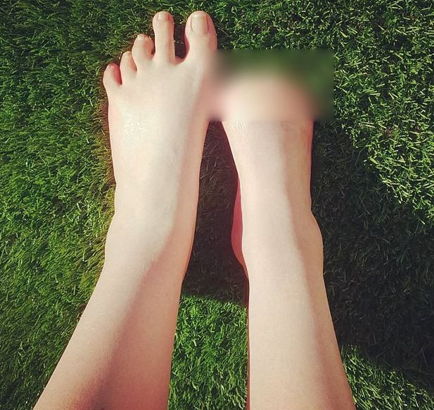 Victorii usunięto wszystkie palce u prawej stopy