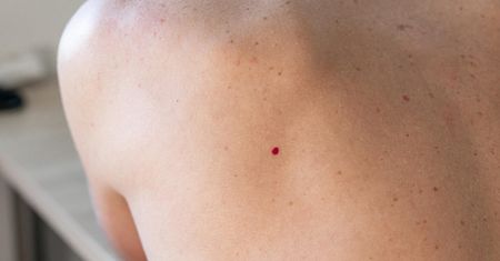 Masz na ciele "rubinki"? Lepiej od razu idź do lekarza