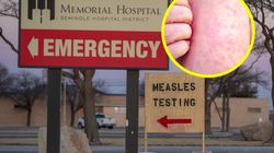 Kolejny zgon z powodu odry w USA. Zmarła 8-letnia dziewczynka