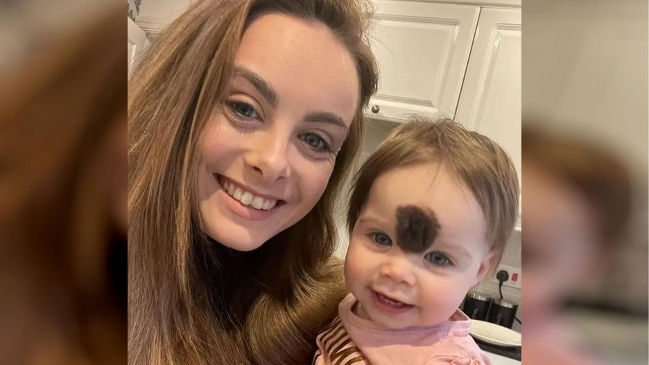 Dziewczynka urodziła się z rzadkim znamieniem. Rodzice postanowili je usunąć: "chcemy, żeby żyła normalnie"