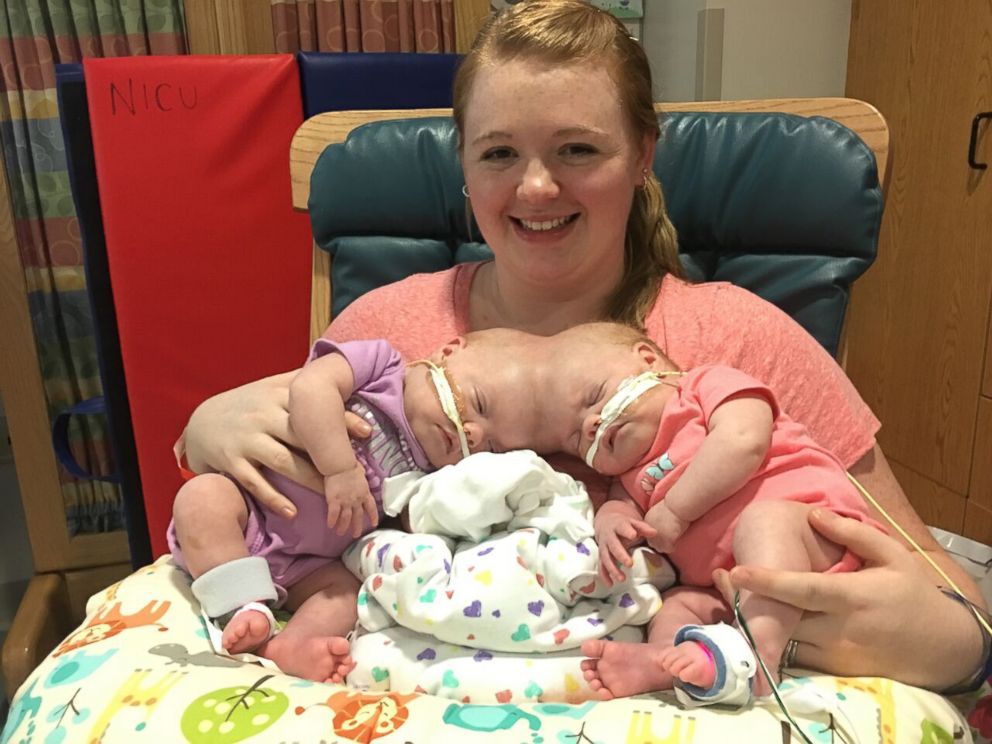 Erin i Abby po urodzeniu