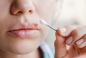 Domowe sposoby na opryszczkę. Przyczyny i objawy opryszczki
