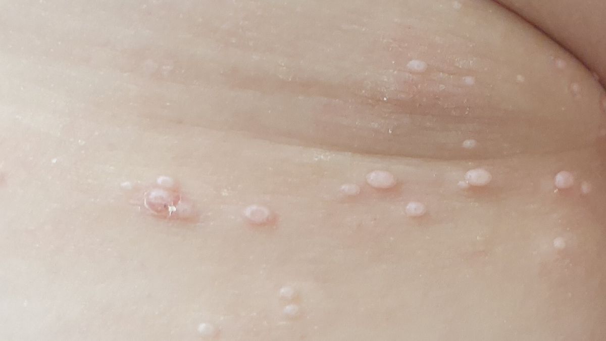 Mięczak zakaźny – jak leczyć u dzieci i u dorosłych?