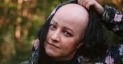 ''Choroba wrażliwców''. Marta pięć lat temu straciła wszystkie włosy