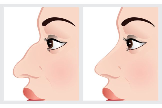 Usunięcie garbu na nosie może wpłynąć pozytywnie na wygląd całej twarzy