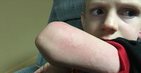 Dziwna wysypka u dziecka była objawem grypy. Matka ostrzega innych rodziców (WIDEO)
