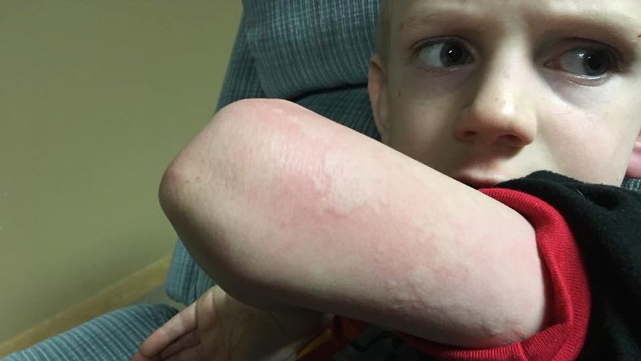 Dziwna wysypka u dziecka była objawem grypy. Matka ostrzega innych rodziców (WIDEO)